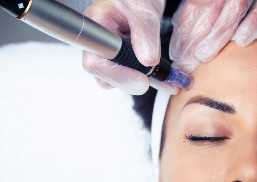 Microneedling Results: What to Expect on Day 2